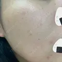 ルメッカ Belle Via Skin Clinic DAY 5 サムネイル用