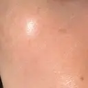 ニードルRF（ポテンツァなど） 広島プルミエクリニック DAY 2 サムネイル用