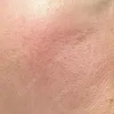 ニードルRF（ポテンツァなど） 広島プルミエクリニック DAY 3 サムネイル用