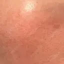 ニードルRF（ポテンツァなど） 広島プルミエクリニック DAY 4 サムネイル用