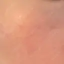 ニードルRF（ポテンツァなど） 広島プルミエクリニック DAY 6 サムネイル用