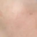 ニードルRF（ポテンツァなど） 広島プルミエクリニック DAY 7 サムネイル用