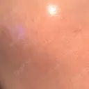 ニードルRF（ポテンツァなど） 広島プルミエクリニック DAY 9 サムネイル用