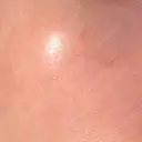 ニードルRF（ポテンツァなど） 広島プルミエクリニック DAY 12 サムネイル用