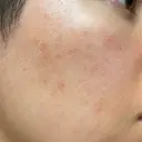 ルメッカ ルラ美容クリニック 大宮院 / ルラスキンクリニック 大宮院 DAY 2 サムネイル用