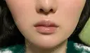 ボトックス（エラ・小顔） / ヒアルロン酸注入（唇） / ボトックス（口角） / ボトックス（人中） L‘amour clinic Tokyo【ラムールクリニック東京】 DAY 7 サムネイル用