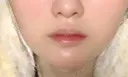 ボトックス（エラ・小顔） / ヒアルロン酸注入（唇） / ボトックス（口角） / ボトックス（人中） L‘amour clinic Tokyo【ラムールクリニック東京】 DAY 15 サムネイル用