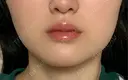 ボトックス（エラ・小顔） / ヒアルロン酸注入（唇） / ボトックス（口角） / ボトックス（人中） L‘amour clinic Tokyo【ラムールクリニック東京】 DAY 16 サムネイル用