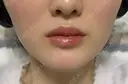ボトックス（エラ・小顔） / ヒアルロン酸注入（唇） / ボトックス（口角） / ボトックス（人中） L‘amour clinic Tokyo【ラムールクリニック東京】 DAY 42 サムネイル用