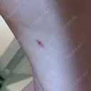 脂肪溶解注射 カイ整形外科・皮膚科 DAY 41 サムネイル用