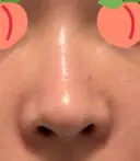 鼻尖形成（切開） / 骨削り（頬） / 軟骨移植 / 鼻孔縁挙上 THE ROPPONGI CLINIC（ザ 六本木クリニック） DAY 275 サムネイル用
