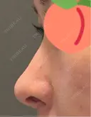 鼻尖形成（切開） / 骨削り（頬） / 軟骨移植 / 鼻孔縁挙上 THE ROPPONGI CLINIC（ザ 六本木クリニック） DAY 275 サムネイル用