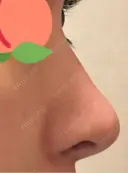 鼻尖形成（切開） / 骨削り（頬） / 軟骨移植 / 鼻孔縁挙上 THE ROPPONGI CLINIC（ザ 六本木クリニック） DAY 275 サムネイル用