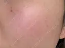 シミ取りレーザー / アートメイク（眉） 筋肉・美容クリニック DAY 13 サムネイル用