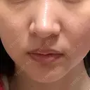 RF（高周波）たるみ治療 あいちビューティークリニック DAY 19 サムネイル用