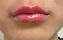 人中短縮 / ヒアルロン酸注入（唇） / ボトックス（口角） ルラ美容クリニック 名古屋栄院 / ルラスキンクリニック 名古屋栄院 DAY 1 サムネイル用
