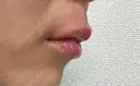 人中短縮 / ヒアルロン酸注入（唇） / ボトックス（口角） ルラ美容クリニック 名古屋栄院 / ルラスキンクリニック 名古屋栄院 DAY 1 サムネイル用