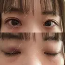 二重埋没 / 眼瞼下垂（非切開） OMI CLINIC 【オミクリニック】 DAY 0 サムネイル用