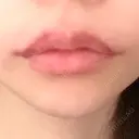 ヒアルロン酸注入（唇） / ボトックス（口角） BON BON CLINIC 銀座駅前本院 AFTER サムネイル用