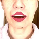 ボトックス（エラ・小顔） / ヒアルロン酸注入（頬） 新未来クリニック DAY 1 サムネイル用