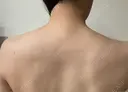 ボトックス（肩） ちぐさ内科クリニック 覚王山 AFTER サムネイル用