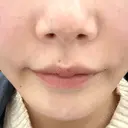 ボトックス（口角） / ボトックス（額） / ハイフ（顔） TCB東京中央美容外科 広島院 DAY 0 サムネイル用