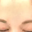 ボトックス（口角） / ボトックス（額） / ハイフ（顔） TCB東京中央美容外科 広島院 DAY 0 サムネイル用