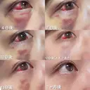 クマ治療 PRISM Beauty Clinic 町田院 AFTER サムネイル用