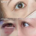 クマ治療 PRISM Beauty Clinic 町田院 DAY 0 サムネイル用