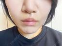 その他（鼻） / 人中短縮 / 鼻柱下降・鼻唇角形成（猫手術） Otus Clinic 【オータスクリニック】 DAY 16 サムネイル用