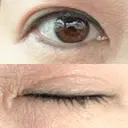 二重埋没 / ヒアルロン酸注入（目の下） アーティスクリニック 博多 DAY 5 サムネイル用