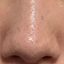 アグネス 日本美容・医療クリニック 六本木院 AFTER サムネイル用