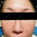 肌育注射（ジュベルックなど） / リジュラン 新宿Ladies&Gentlemen美容クリニック DAY 2 サムネイル用