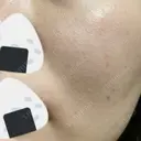 ルメッカ Belle Via Skin Clinic DAY 9 サムネイル用