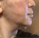 糸リフト / 脂肪吸引（顔） 湘南美容クリニック 千葉センシティ院 DAY 1 サムネイル用