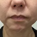 RF（高周波）たるみ治療 大美会クリニック 心斎橋本院 AFTER サムネイル用