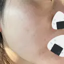 ルメッカ Belle Via Skin Clinic DAY 10 サムネイル用