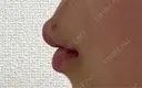 人中短縮 / ヒアルロン酸注入（唇） / ボトックス（口角） ルラ美容クリニック 名古屋栄院 / ルラスキンクリニック 名古屋栄院 DAY 4 サムネイル用