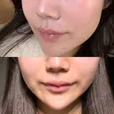 ハイフ（顔） AZ BEAUTY CLINIC AFTER サムネイル用