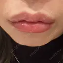 口角挙上 / その他（口元） アネシス美容クリニック AFTER サムネイル用