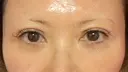 二重埋没 / その他（目元） / クマ治療 / 下まぶたの脂肪取り / 自然癒着法 / ヒアルロン酸注入（目の下） MEMOTO CLINIC 名古屋 DAY 9 サムネイル用