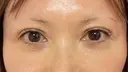 二重埋没 / その他（目元） / クマ治療 / 下まぶたの脂肪取り / 自然癒着法 / ヒアルロン酸注入（目の下） MEMOTO CLINIC 名古屋 DAY 12 サムネイル用