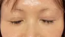 二重埋没 / その他（目元） / クマ治療 / 下まぶたの脂肪取り / 自然癒着法 / ヒアルロン酸注入（目の下） MEMOTO CLINIC 名古屋 DAY 12 サムネイル用