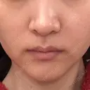 RF（高周波）たるみ治療 あいちビューティークリニック DAY 24 サムネイル用