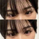 ヒアルロン酸注入（涙袋） AYANAフィラーズクリニック 渋谷院 AFTER サムネイル用