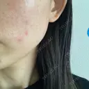 水光注射（ハリ・美肌） Rinato Beauty Clinic DAY 0 サムネイル用