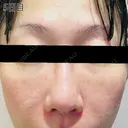 肌育注射（ジュベルックなど） / リジュラン 新宿Ladies&Gentlemen美容クリニック DAY 5 サムネイル用