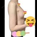 脂肪吸引（二の腕） / 脂肪吸引（脚） / 豊胸（脂肪注入） BBC銀座院 DAY 14 サムネイル用