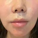 人中短縮 聖心美容クリニック 六本木院 DAY 41 サムネイル用