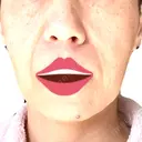 ボトックス（エラ・小顔） / ヒアルロン酸注入（頬） 新未来クリニック DAY 7 サムネイル用